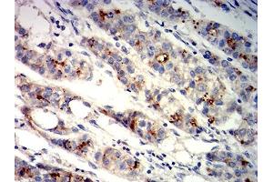 Immunohistochemical analysis of paraffin-embedded liver cancer tissues using GPC3 mouse mAb with DAB staining.