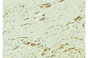 ABIN6276892 at 1/100 staining Human breast cancer tissue by IHC-P. (PTPN2 抗体  (C-Term))