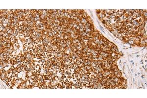 Immunohistochemistry of paraffin-embedded Human cervical cancer using AK2 Polyclonal Antibody at dilution of 1:40 (Adenylate Kinase 2 抗体)