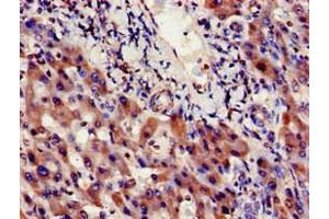 Immunohistochemistry of paraffin-embedded human liver cancer using ABIN7156348 at dilution of 1:100 (INSIG1 抗体  (AA 1-87))