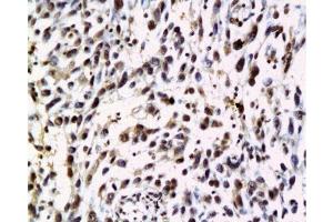 Formalin-fixed and paraffin embedded human cervical carcinoma labeled with Anti-NRAS Polyclonal Antibody, Unconjugated  at 1:200 followed by conjugation to the secondary antibody and DAB staining. (GTPase NRas 抗体  (AA 101-189))