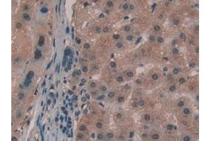 Detection of GaA in Human Liver cancer Tissue using Polyclonal Antibody to Glucosidase Alpha, Acid (GaA) (GAA 抗体  (AA 595-770))