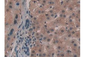 Detection of GaA in Human Liver cancer Tissue using Polyclonal Antibody to Glucosidase Alpha, Acid (GaA) (GAA 抗体  (AA 595-770))