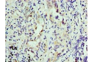 Immunohistochemistry of paraffin-embedded human lung cancer using ABIN7156126 at dilution of 1:100 (KPNA1 抗体  (AA 8-538))