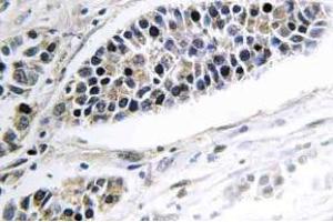 Immunohistochemistry (IHC) analyzes of KDEL Receptor 2 antibody in paraffin-embedded human lung carcinoma tissue. (KDELR2 抗体)