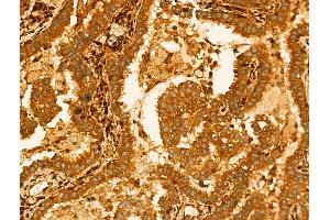ABIN7094259 and ABIN7098306 at 1/100 staining Human lung cancer by IHC-P. (GLTP 抗体  (Internal Region))