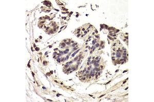 Immunohistochemistry of paraffin-embedded human breast cancer using INTS6 Antibody. (INTS6 抗体  (AA 1-280))