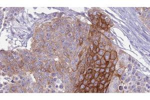 ABIN6279169 at 1/100 staining Human urothelial cancer tissue by IHC-P. (ABCC9 抗体  (C-Term))