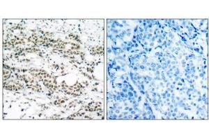 Immunohistochemical analysis of paraffin- embedded human breast carcinoma tissue using AFX (phospho-Ser197) antibody (E011137). (FOXO4 抗体  (pSer197))