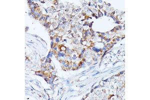 Immunohistochemistry of paraffin-embedded human breast cancer using KCNJ15 antibody (ABIN7269475) at dilution of 1:100 (40x lens). (KCNJ15 抗体  (AA 221-375))