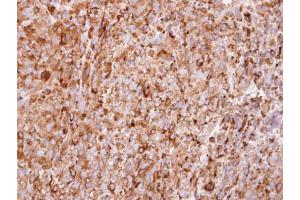 IHC-P Image Immunohistochemical analysis of paraffin-embedded CL1-5 xenograft, using interferon alpha 2, antibody at 1:100 dilution. (IFNA2 抗体  (C-Term))