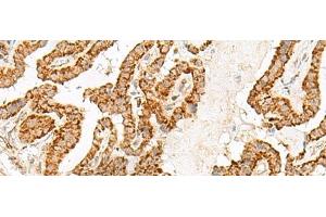 Immunohistochemistry of paraffin-embedded Human thyroid cancer tissue using NUP210 Polyclonal Antibody at dilution of 1:30(x200) (NUP210 抗体)