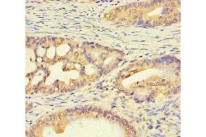 Immunohistochemistry of paraffin-embedded human colon cancer using ABIN7174792 at dilution of 1:100 (C1ORF53 抗体  (AA 1-145))