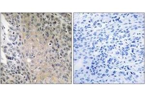 Immunohistochemistry analysis of paraffin-embedded human lung carcinoma, using RAB41 Antibody. (RAB41 抗体  (AA 115-164))