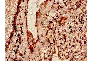Immunohistochemistry of paraffin-embedded human lung cancer using ABIN7159758 at dilution of 1:100 (MAP4 抗体  (AA 575-818))