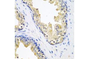 Immunohistochemistry of paraffin-embedded human prostate using SPINT2 antibody (ABIN5974082) at dilution of 1/200 (40x lens). (SPINT2 抗体)