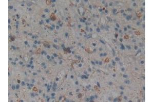 Detection of MAPK11 in Human Glioma Tissue using Polyclonal Antibody to Mitogen Activated Protein Kinase 11 (MAPK11) (MAPK11 抗体  (AA 38-277))