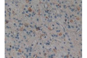 Detection of MAPK11 in Human Glioma Tissue using Polyclonal Antibody to Mitogen Activated Protein Kinase 11 (MAPK11)