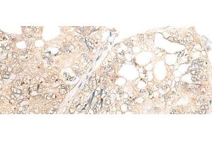 Immunohistochemistry of paraffin-embedded Human gastric cancer tissue using DCP2 Polyclonal Antibody at dilution of 1:45(x200) (DCP2 抗体)