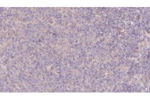 ABIN6273077 at 1/100 staining Human lymph cancer tissue by IHC-P. (SRP9 抗体  (Internal Region))