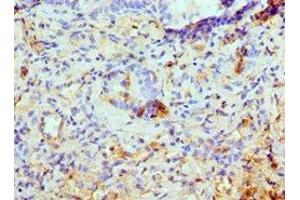 Immunohistochemistry of paraffin-embedded human lung cancer using ABIN7145103 at dilution of 1:100 (ATG13 抗体  (AA 318-517))