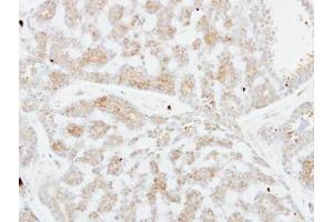 IHC-P Image Immunohistochemical analysis of paraffin-embedded human breast cancer, using FSTL1, antibody at 1:250 dilution. (FSTL1 抗体  (C-Term))