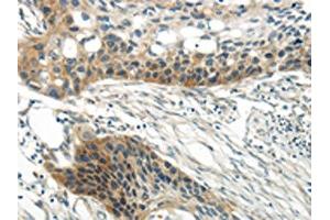 The image on the left is immunohistochemistry of paraffin-embedded Human esophagus cancer tissue using ABIN7193067(WNT6 Antibody) at dilution 1/35, on the right is treated with synthetic peptide. (WNT6 抗体)