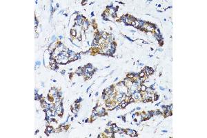 Immunohistochemistry of paraffin-embedded human breast cancer using ATG7 antibody (ABIN6292614) at dilution of 1:100 (40x lens).