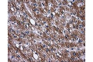Immunohistochemical staining of paraffin-embedded Carcinoma of liver tissue using anti-PASKmouse monoclonal antibody. (PASK 抗体)
