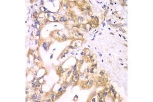 Immunohistochemistry of paraffin-embedded human liver cancer using ACADS antibody.