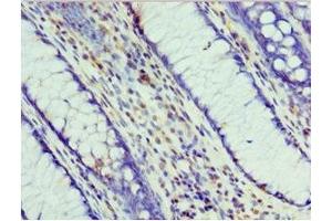 Immunohistochemistry of paraffin-embedded human colon cancer using ABIN7164708 at dilution of 1:100 (Prohibitin 2 抗体  (AA 1-299))