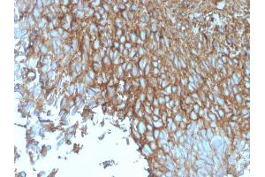 Formalin-fixed, paraffin-embedded human Bladder stained with GLUT-1 Mouse Monoclonal Antibody (rGLUT1/2476). (Recombinant GLUT1 抗体  (AA 203-305))
