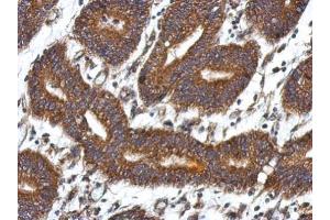 IHC-P Image Immunohistochemical analysis of paraffin-embedded human colon carcinoma, using QDPR, antibody at 1:500 dilution. (QDPR 抗体)