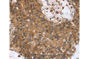 Immunohistochemistry of Human lung cancer using TPM2 Polyclonal Antibody at dilution of 1:35 (TPM2 抗体)