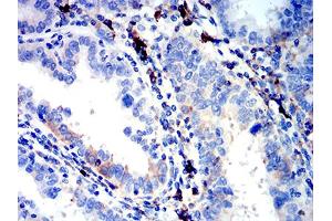 Immunohistochemical analysis of paraffin-embedded endometrial cancer tissues using IGLC2 mouse mAb with DAB staining. (IGLC2 抗体  (AA 1-106))