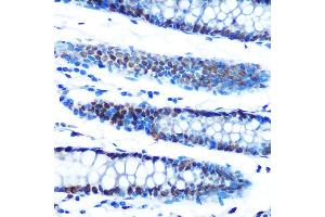 Immunohistochemistry of paraffin-embedded human colon using  Rabbit mAb (ABIN7265458) at dilution of 1:100 (40x lens). (ADAR 抗体)