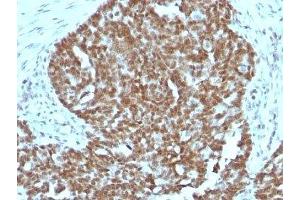 Formalin-fixed, paraffin-embedded human ovarian carcinoma stained with Nucleolin antibody. (Nucleolin 抗体)