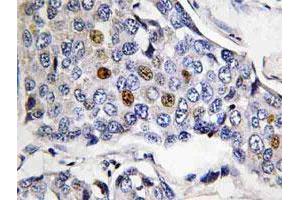 Immunohistochemical analysis of paraffin-embedded human breast cancer tissue using POLR3A polyclonal antibody . (POLR3A 抗体)