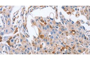 Immunohistochemistry of paraffin-embedded Human lung cancer tissue using NRG4 Polyclonal Antibody at dilution 1:60 (Neuregulin 4 抗体)