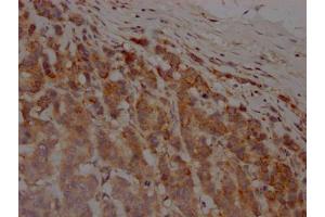 IHC image of ABIN7127624 diluted at 1:100 and staining in paraffin-embedded human breast cancer performed on a Leica BondTM system. (Recombinant MMP12 抗体)