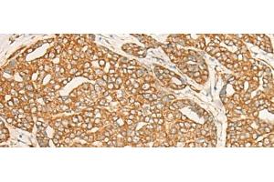 Immunohistochemistry of paraffin-embedded Human liver cancer tissue using DARS Polyclonal Antibody at dilution of 1:25(x200) (DARS 抗体)