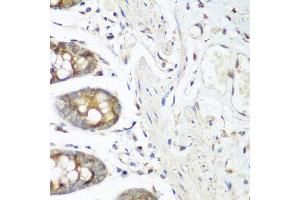 Immunohistochemistry of paraffin-embedded human colon using FLT4 antibody at dilution of 1:200 (40x lens).