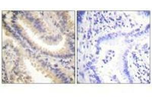 Immunohistochemistry analysis of paraffin-embedded human lung carcinoma tissue using TIMP4 antibody. (TIMP4 抗体  (C-Term))