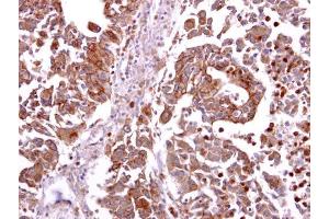 IHC-P Image CCR8 antibody detects CCR8 protein at cytosol and membrane on human hepatoma by immunohistochemical analysis. (CCR8 抗体  (C-Term))