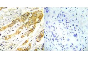 Immunohistochemical analysis of paraffin- embedded human breast carcinoma tissue using ERK1/2 (Thr202/Tyr204) antibody (E022017). (ERK1/2 抗体)