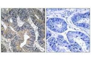 Immunohistochemistry analysis of paraffin-embedded human colon carcinoma tissue using GTPBP2 antibody. (GTPBP2 抗体)