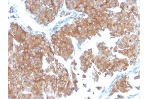 Formalin-fixed, paraffin-embedded human Urothelial Carcinoma stained with PAI-RBP1 Mouse Monoclonal Antibody (SERBP1/3498).