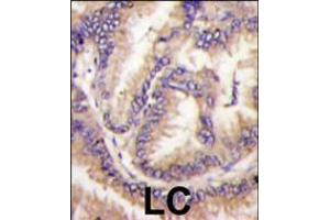 Formalin-fixed and paraffin-embedded human lung carcinoma tissue reacted with STK9 Antibody , which was peroxidase-conjugated to the secondary antibody, followed by DAB staining. (CDKL5 抗体  (C-Term))