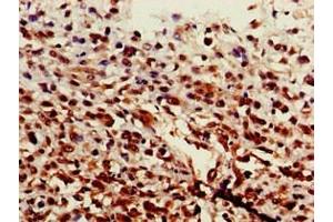 Immunohistochemistry of paraffin-embedded human melanoma using ABIN7143911 at dilution of 1:100 (ST6GALNAC1 抗体  (AA 36-249))