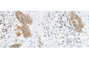 Immunohistochemistry of paraffin-embedded Human esophagus cancer tissue using LPXN Polyclonal Antibody at dilution of 1:60(x200) (Leupaxin 抗体)